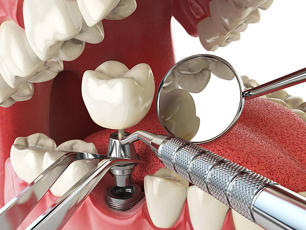 Best Emergency Root Canal Treatment in Worthington, OH